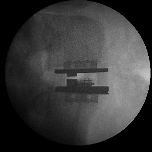 Intervertebral Disc Implant, additional view