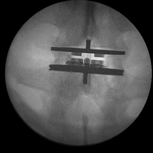 Intervertebral Disc Implant, additional view